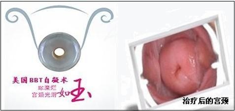 BBT自凝技术