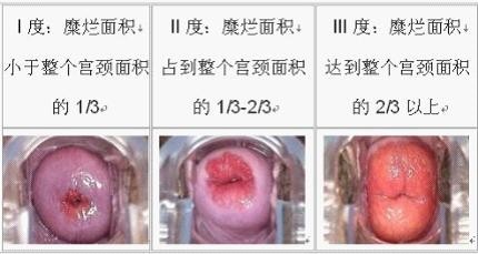 宫颈糜烂不同程度的病变