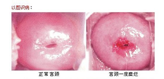 宫颈糜烂轻度