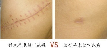 腹腔镜技术