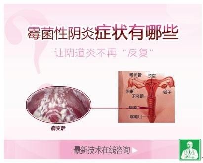 霉菌性阴道炎 霉菌性阴道炎