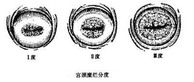 宫颈糜烂