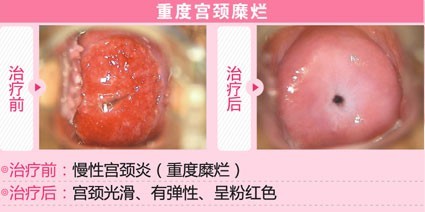 宫颈糜烂治疗前后对比图